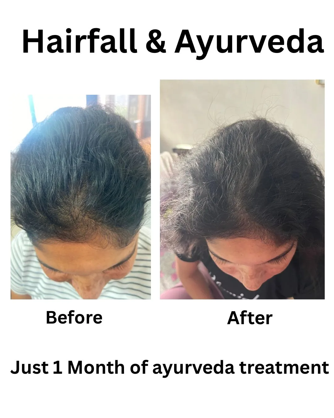 Hairfall & Ayurveda — 1 month