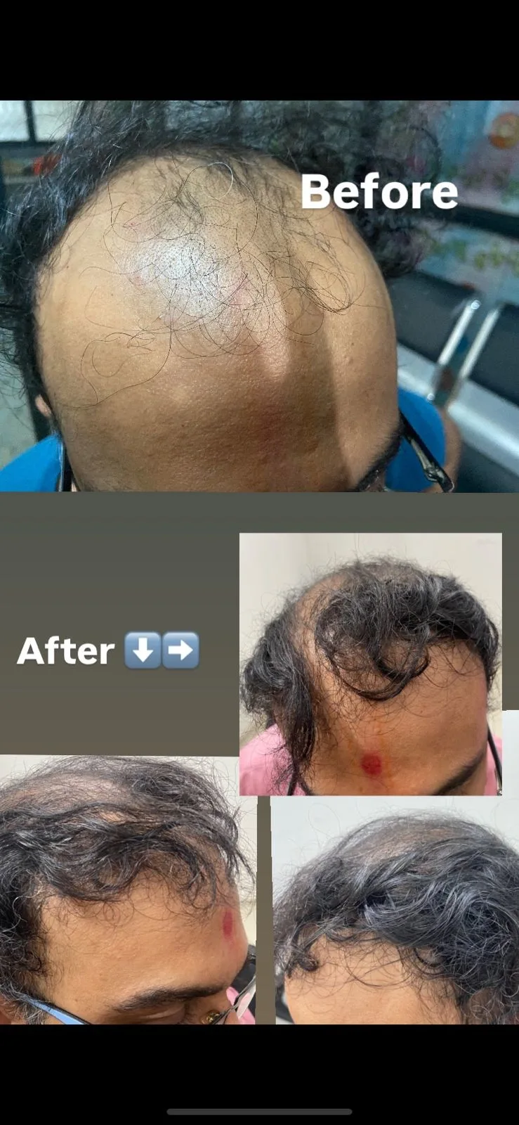 Hairfall & Ayurveda