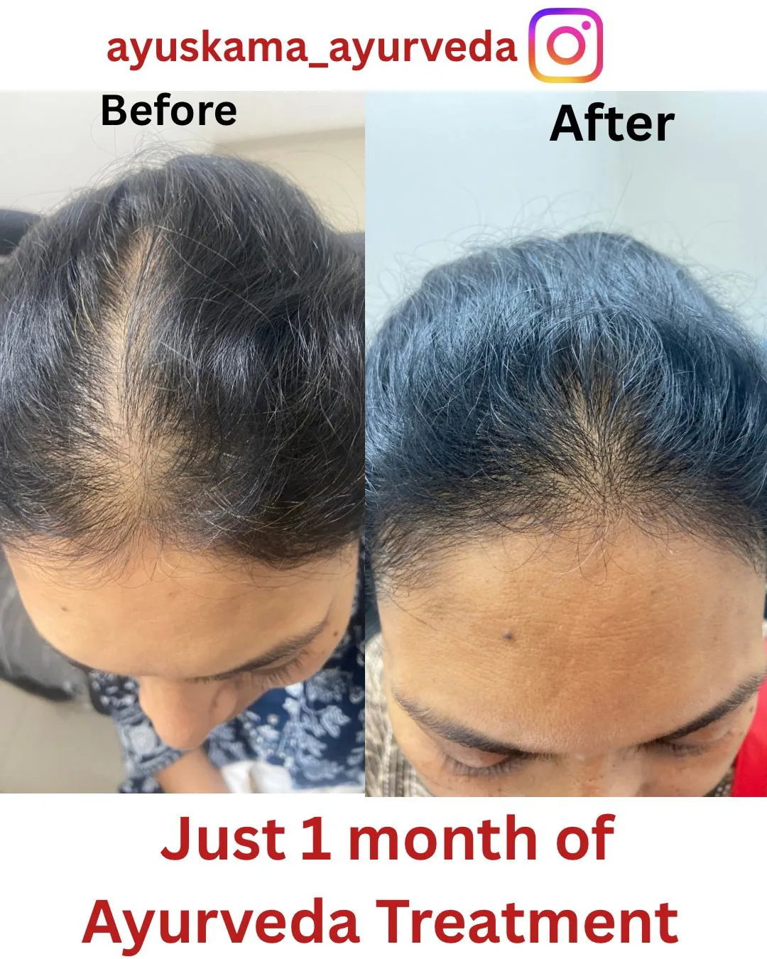 Hairfall & Ayurveda — 1 month
