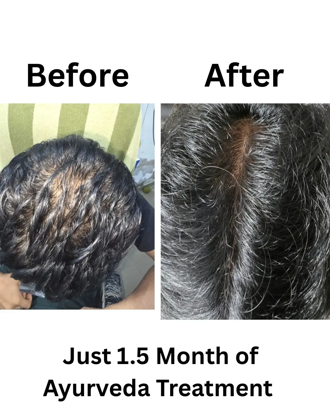 Hairfall & Ayurveda — 1.5 months