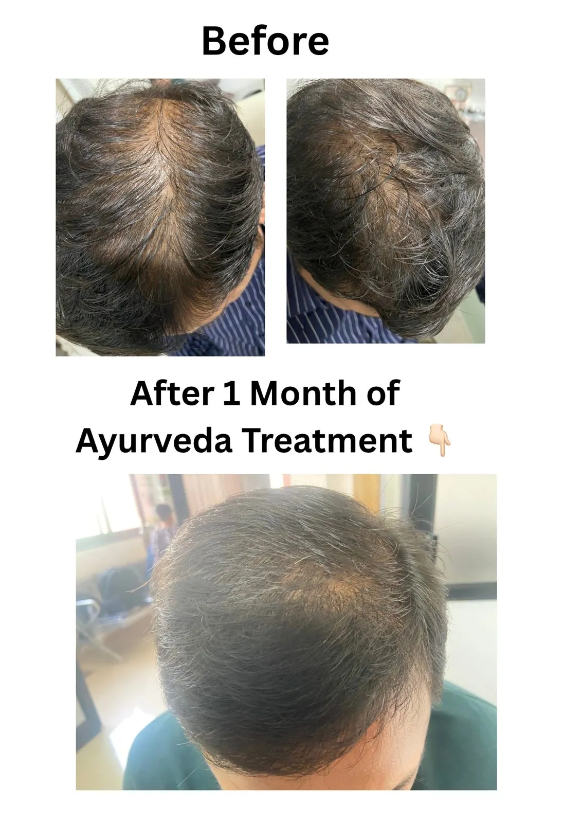 Hairfall & Ayurveda — 1 month