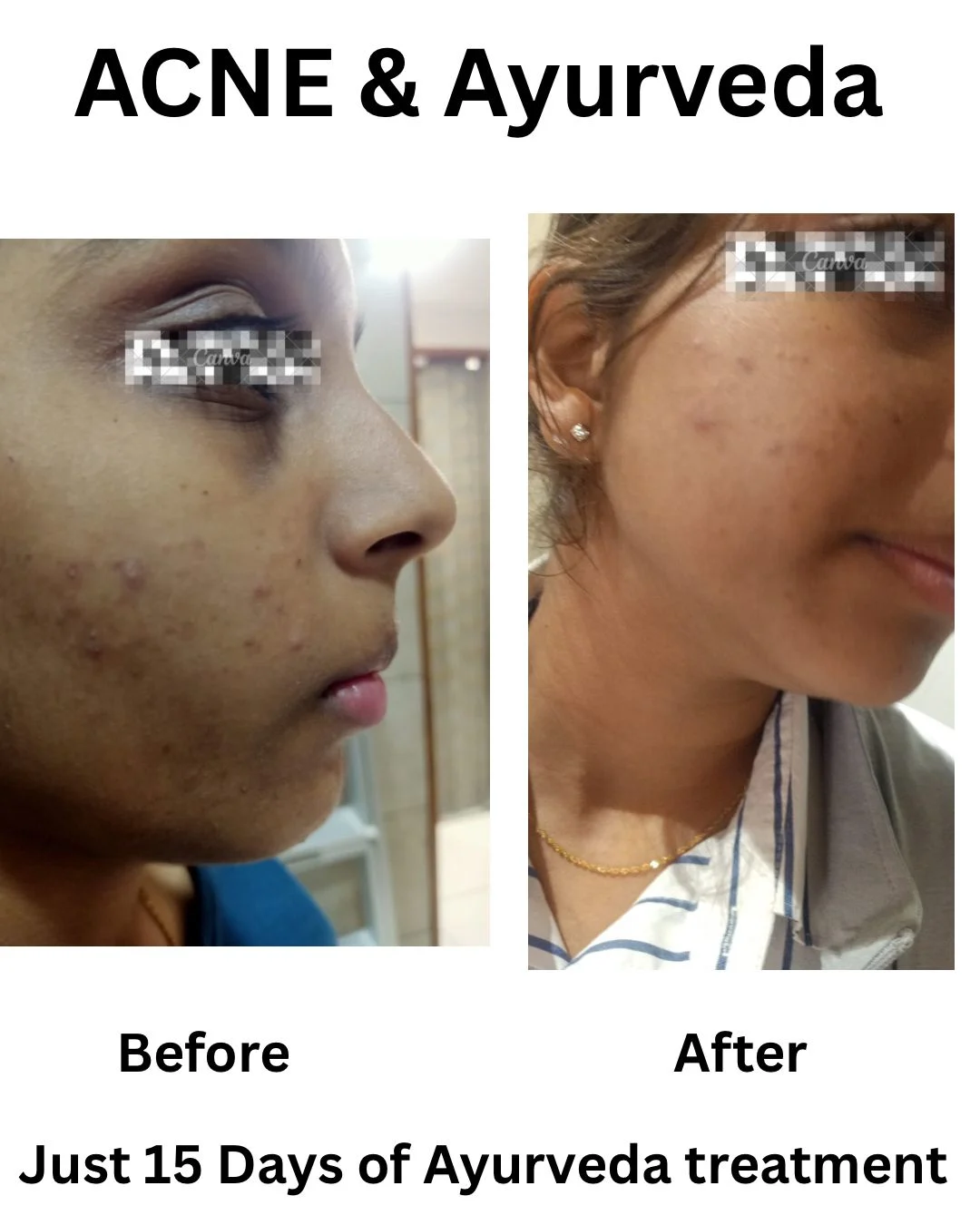 Acne & Ayurveda — 15 days